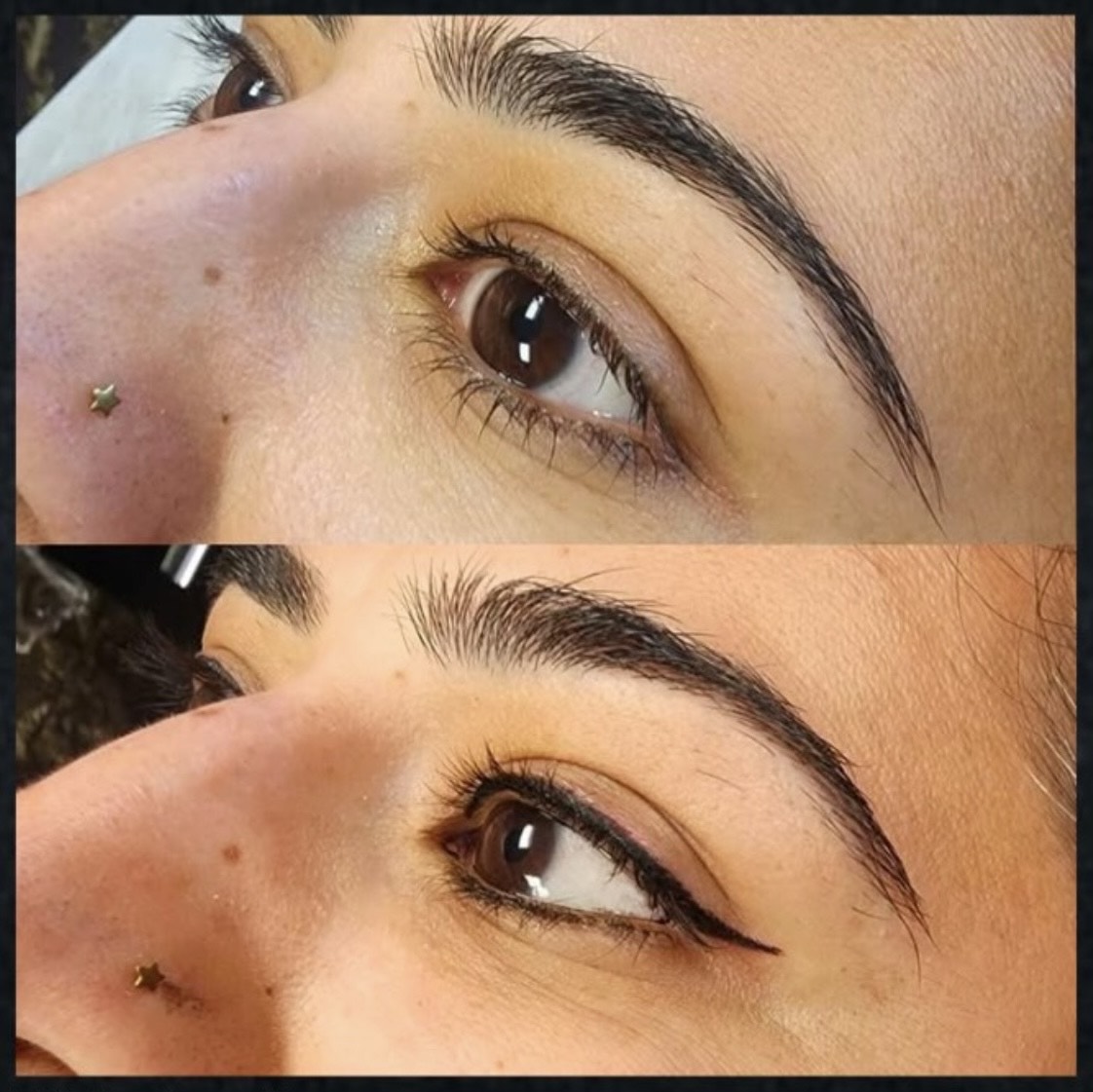 Laser tattoo removal on hand by Kat