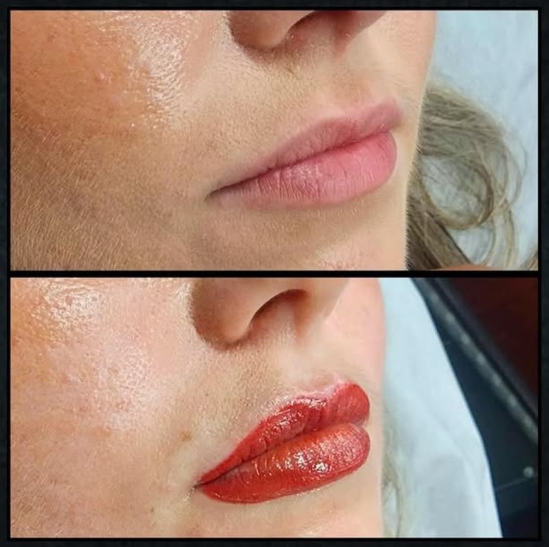 Laser tattoo removal progress by Kat